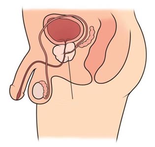 Enlarged Prostate